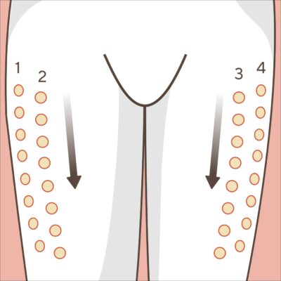 Die Illustration zeigt gezeichnete Oberschenkel einer Person. Hier sind sogenannte Spritzreihen dargestellt. Am äußeren rechten Oberschenkel ganz oben steht die Ziffer 1, darunter befinden sich Punkte. Daneben ist eine zweite Reihe mit markierten Einstichstellen. Am 2. Oberschenkel sind ebenfalls 2 Reihen dargestellt, die mit Punkten (mit ca. 2 cm Abstand) die Einstichstellen zeigen. 